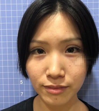 苏州小妹纸在康美张武医生做的鼻子果怎样?