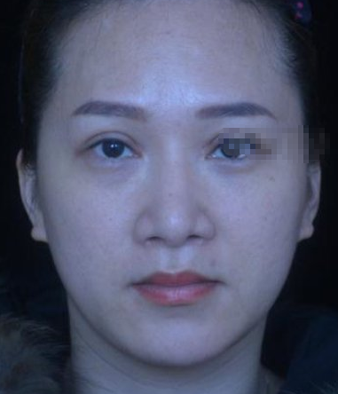 南宁寻美姐姐梦想整形美容注射瘦脸术后果分享