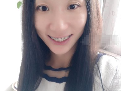 青岛优诺博士口腔医院怎样?矫正牙齿对比图分