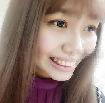 深圳小姐姐牙齿矫正术后分享 福华口腔果好吗
