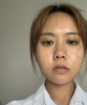 面部埋线提升提升果?北京明德医院案例附图展示