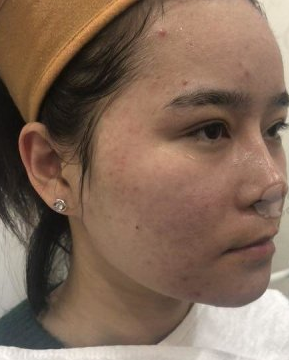 北京欧华医疗美容像素激光有没有果?