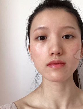 北京明德医院激光美肤激光术后83天果附对比图分享