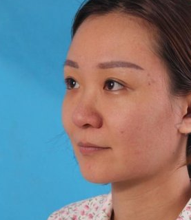 北京美莱医疗美容肋软骨隆鼻果怎么样?