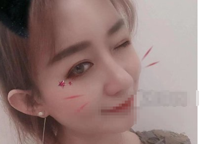 北京美莱医疗美容肋软骨隆鼻果怎么样?