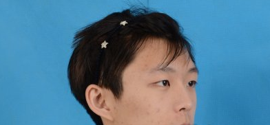 叶宇割双眼皮咋样？北京美莱医美眼部手术案例