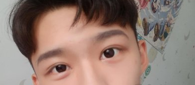 叶宇割双眼皮咋样？北京美莱医美眼部手术案例