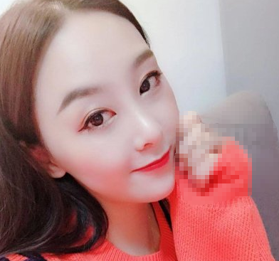 耳软骨隆鼻修复,北京亚楠容悦蒋亚楠医生案例