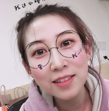 北京亚楠容悦医美医生任影面部吸脂案例分享