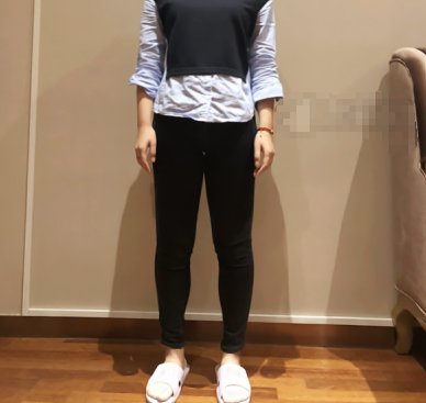 北京英煌医疗美容大腿吸脂果怎么样?