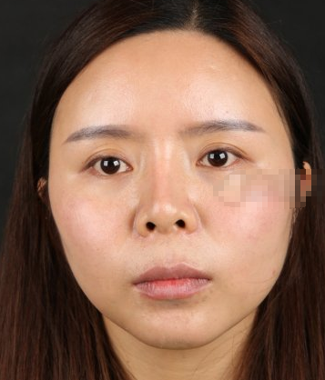四川华美紫馨苏辰枫肋软骨隆鼻咋样?案例一览