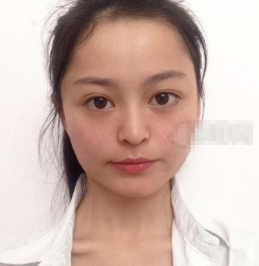 成都格莱丽整形美容面部吸脂果到底好不好？