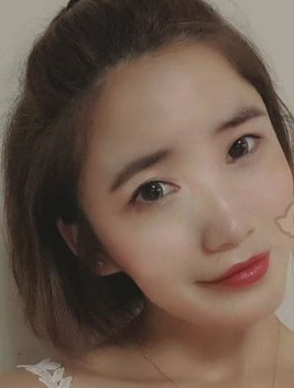 梁军隆鼻果好吗？四川美莱肋软骨隆鼻案例