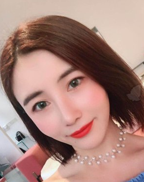 梁军隆鼻果好吗？四川美莱肋软骨隆鼻案例