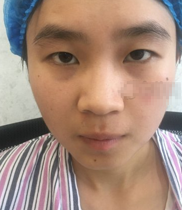重庆珂琳雅医美王陈医生鼻部手术案例分享