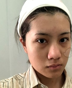邓兵隆鼻果怎样？成都圣丹福整形鼻部手术案例