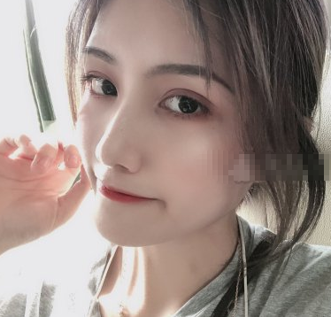 邓兵隆鼻果怎样？成都圣丹福整形鼻部手术案例