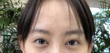 埋线双眼皮好不呢?广州妹纸宸山医美程宁医生