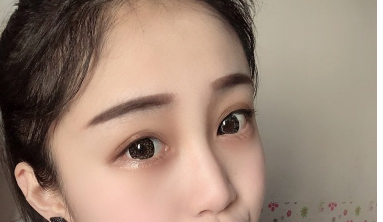 北京艺星医疗医生王博谦切开双眼皮案例分享！