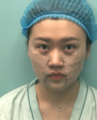 北京首玺丽格医疗美容诊所医生沈波埋线提升提升
