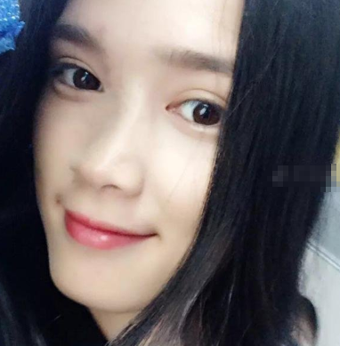 宁波美莱整形医生孙明磊鼻部多项案例分享!