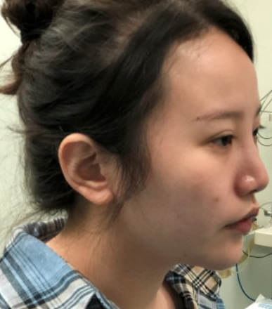 合肥亚典美容医院埋线提升案例分享!