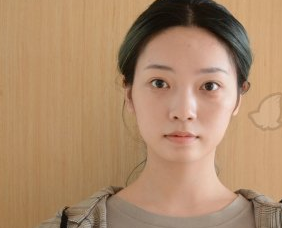 温州百佳东方医学美容硅胶隆下巴案例分享!