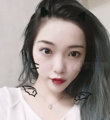 温州百佳东方医学美容硅胶隆下巴案例分享!