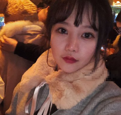 合肥亚典美容医院埋线提升案例分享!