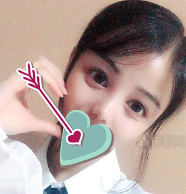 成都素美医疗美容假体隆鼻术后感受分享