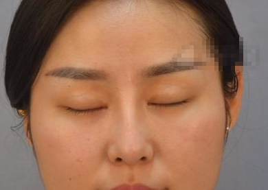 深圳阳光整形美容医院眼部多项案例分享!