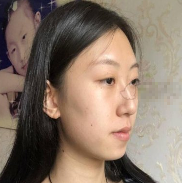 陕西西安美立方隆鼻果好吗 李旭平隆鼻案例