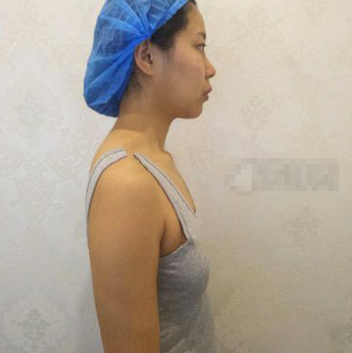 海南韩美隆胸咋样啦?真人案例有吗?