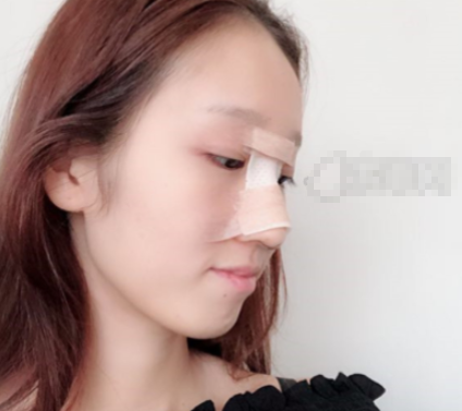 成都华美整形隆鼻好不好?隆鼻案例附图分享
