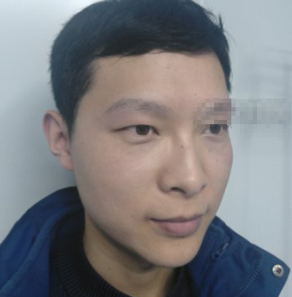 假体丰太阳穴咋样?艾莱美医疗整形叶华案例