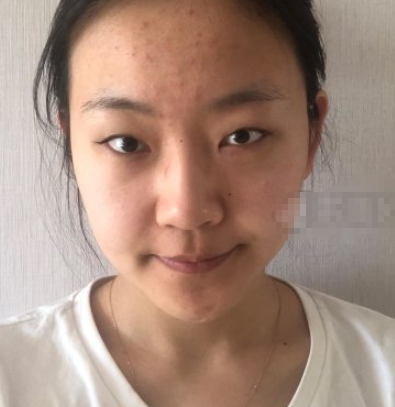 武汉柠悦医美割双眼皮好不好?有案例吗?