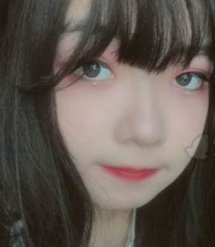 武汉蜜儿优年医疗整形假体垫下巴案例分享