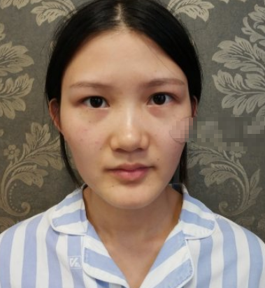 湖北武汉新至美隆鼻如何？有隆鼻的案例吗？