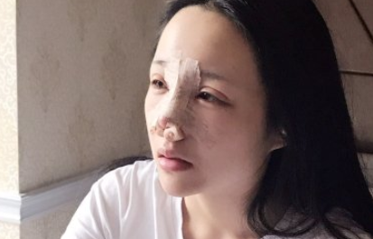 武汉一美李兰华隆鼻好不好?小姐姐案例&价格表