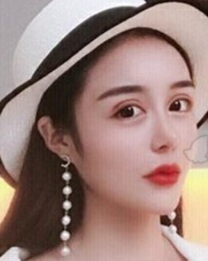 武汉一美李兰华隆鼻好不好?小姐姐案例&价格表