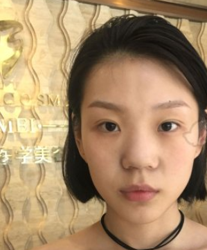 做鼻部手术好不好?武汉一美医疗美容汪利龙案例