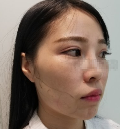 深圳艺星面部吸脂好不好？吸脂的案例有吗？