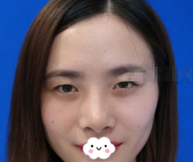 重庆艺星整形双眼皮靠谱吗？眼部手术案例分享