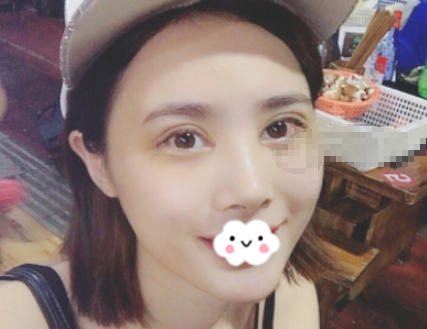 重庆艺星整形双眼皮靠谱吗？眼部手术案例分享