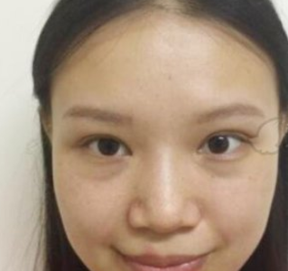 成都米兰柏羽整形陈波隆鼻案例分享附对比图