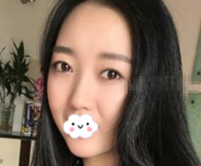米兰柏羽玻尿酸隆鼻果咋样呢？看下这个案例