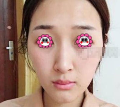 深圳阳光整形罗志敏做假体隆鼻好不好?案例