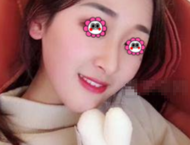 深圳阳光整形罗志敏做假体隆鼻好不好?案例