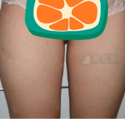 上海玫瑰医学美容吸脂怎样?邹功伟大腿吸脂