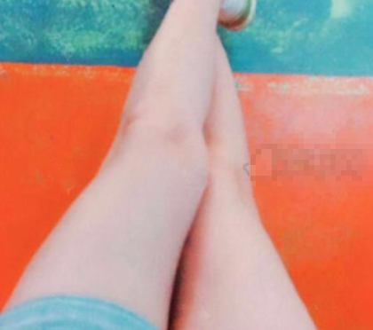 上海玫瑰医学美容吸脂怎样?邹功伟大腿吸脂